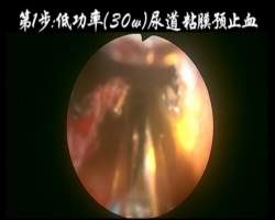 绿激光前列腺汽化术（术者：上海交通大学医学院附属仁济医院孙杰教授）