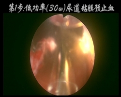 神州组-六步法PVP-杨登科（上海交通大学医学院附属同仁医院）