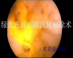 经尿道绿激光前列腺剜除术（术者：北京协和医院徐维锋教授）