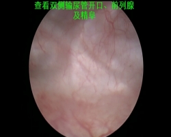 绿激光前列腺汽化术（术者：苏州大学第二医院薛波新教授）