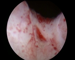中原组-绿激光前列腺剜除术-贾招辉（河南科技大学第一附属医院）