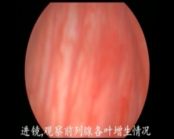 神州组-经尿道前列腺绿激光剜除术--蒋涛（重庆西南医院）