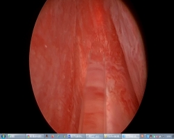 经尿道绿激光前列腺剜除术（术者：安徽医科大学附属第一医院张翼飞教授）-02